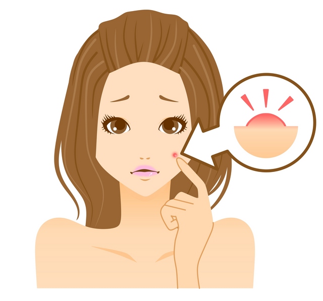 大人ニキビ