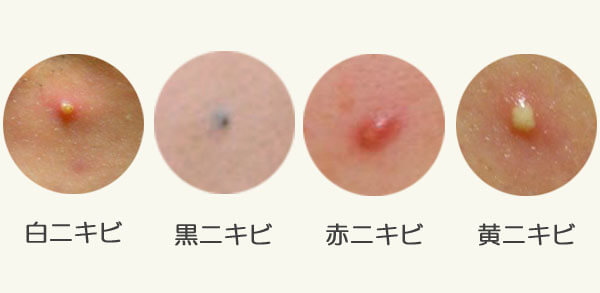 ニキビ