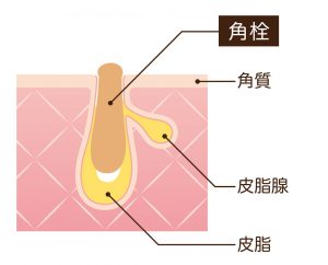 ニキビ
