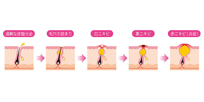 ニキビ