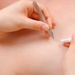 脱毛の種類(ニードル脱毛(針脱毛))